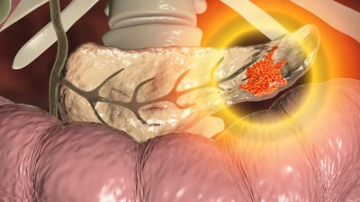 Cancer pancreas: simptome, cauze, tratament