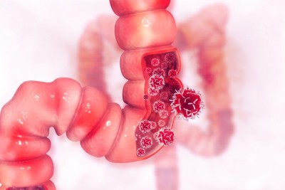 Cancerul de colon : cauze, simptome, diagnostic, tratament