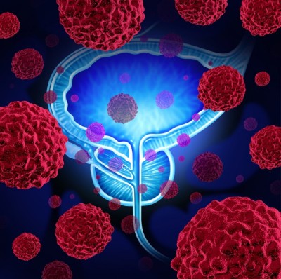 Cancerul de prostata : ce este, cauze, simptome, tipuri, tratament