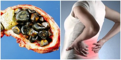 Ce alimente să consumi ca să previi formarea pietrelor la rinichi