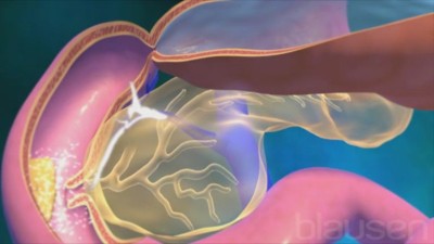 Ce trebuie să știi despre cancerul de esofag - principalele simptome și metode de tratament