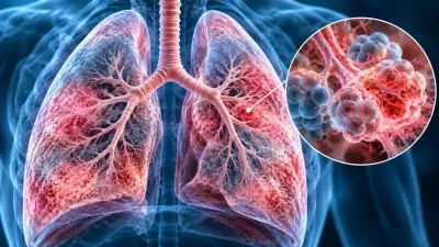 Ilustrație medicală a pneumoniei interstițiale, cu inflamația țesutului pulmonar și detaliu al alveolelor afectate