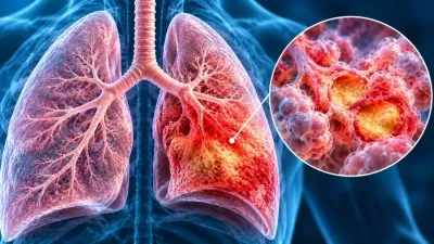 Ilustrație medicală a pneumoniei lobare, cu consolidarea inflamatorie a unui lob pulmonar și alveole afectate