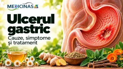 Ulcerul gastric – ilustrație medicală a unei leziuni ulcerative la nivelul mucoasei stomacului
