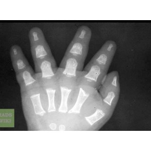 Achondroplasia