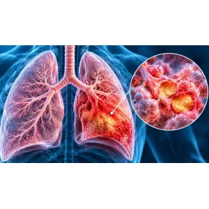 Ilustrație medicală a pneumoniei lobare, cu consolidarea inflamatorie a unui lob pulmonar și alveole afectate