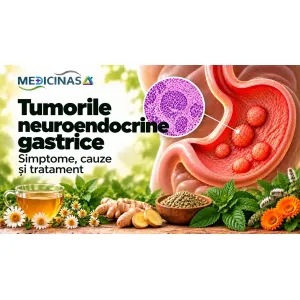 Tumori neuroendocrine gastrice – ilustrație medicală a nodulilor neuroendocrini dezvoltați în peretele stomacului