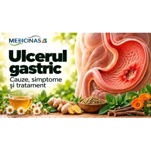 Ulcerul gastric – ilustrație medicală a unei leziuni ulcerative la nivelul mucoasei stomacului