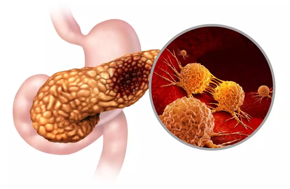 cauze cancerul pancreatic